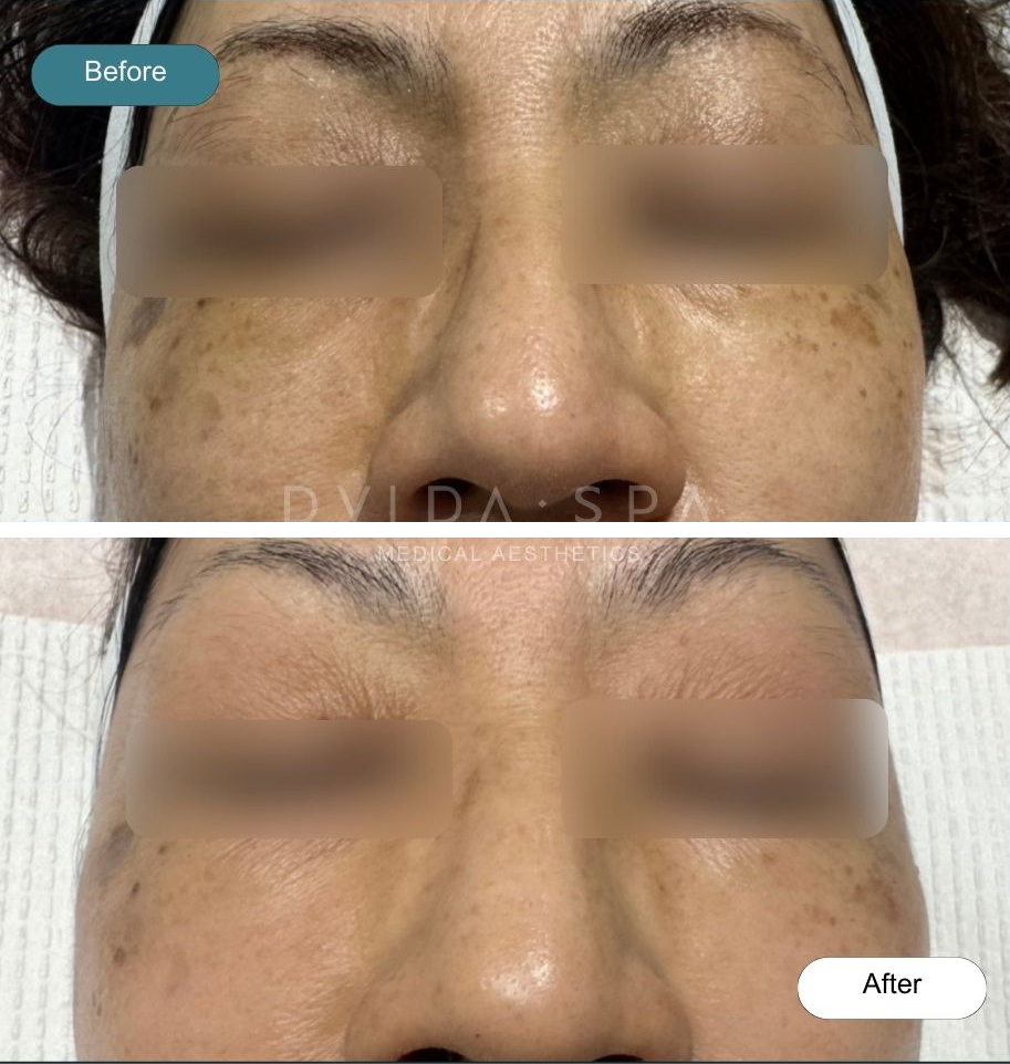 Before and after of SkyfirmX with CoolPeel and Exosomes treatment - Dvida Spa in Chicago and near Raleigh