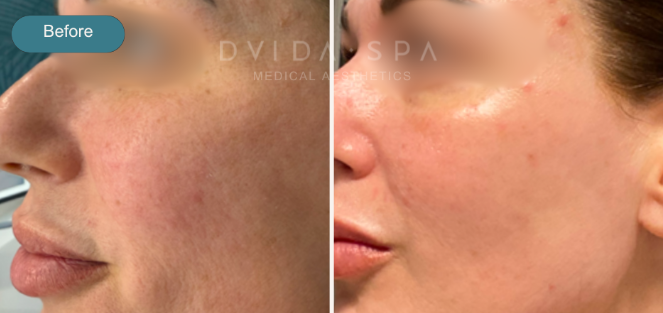 PRP skin rejuvenation