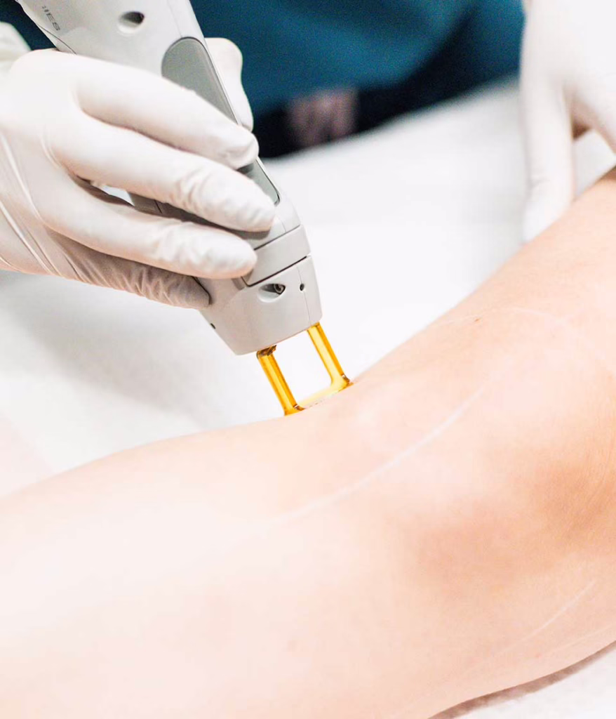 Raleigh laser hair removal on outer knee.