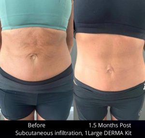Cellenis-Derma-Bio-Filler